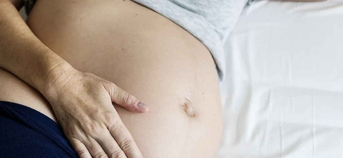 kobieta-w-ciąży-zaburzenia-dermatologiczne-pigmentacyjne-rozstępy