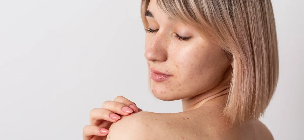 Jak wygląda proces powstawania zmian trądzikowych