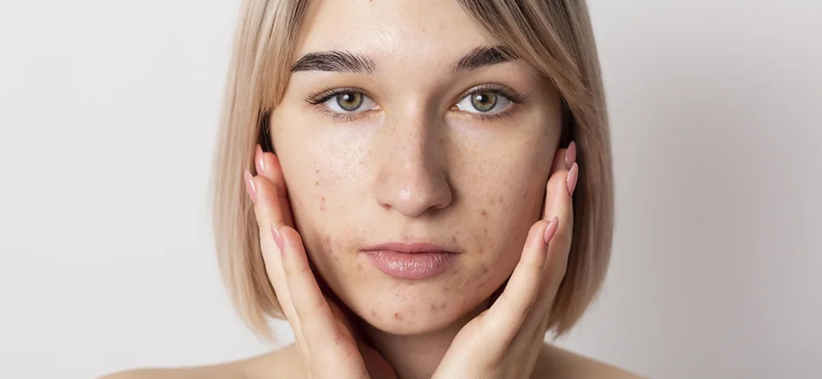 zmiany-trądzikowe