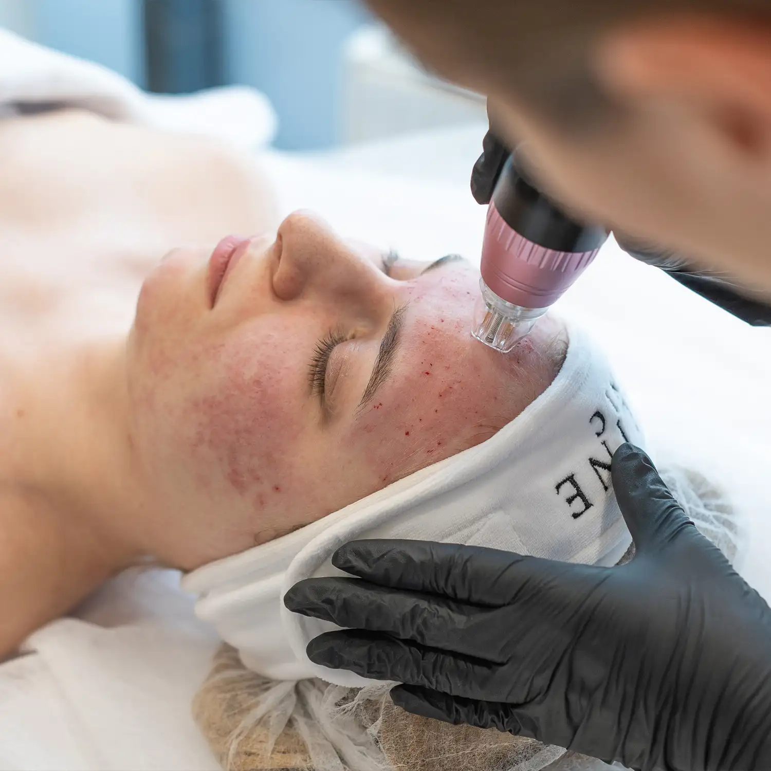 radiofrekwencja-mikroigłowa-skinline-clinic-warszawa-mokotow