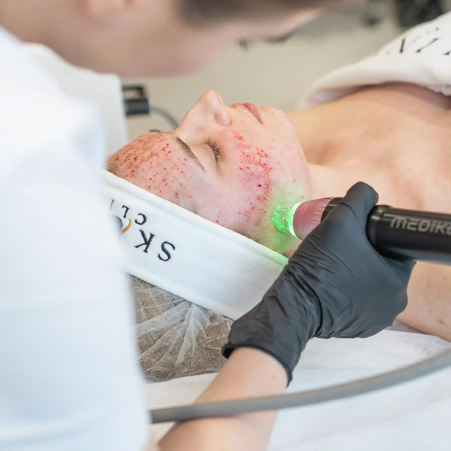 skinline-clinic-warszawa-mokotow-radiofrekwencja-mikroigłowa