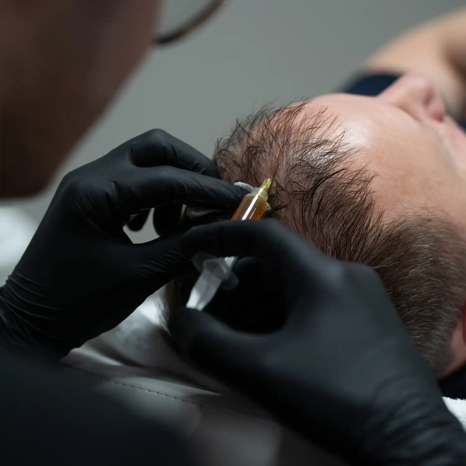 fibryna-bogatoplytkowa-na-skore-glowy-warszawa-skinline-clinic-mokotow