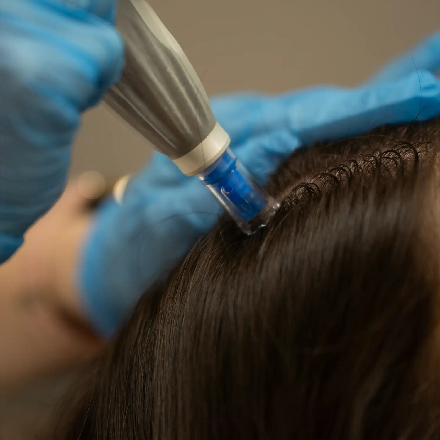 mezoterapia-mikroiglowa-skory-glowy-warszawa-mokotow-skinline-clinic