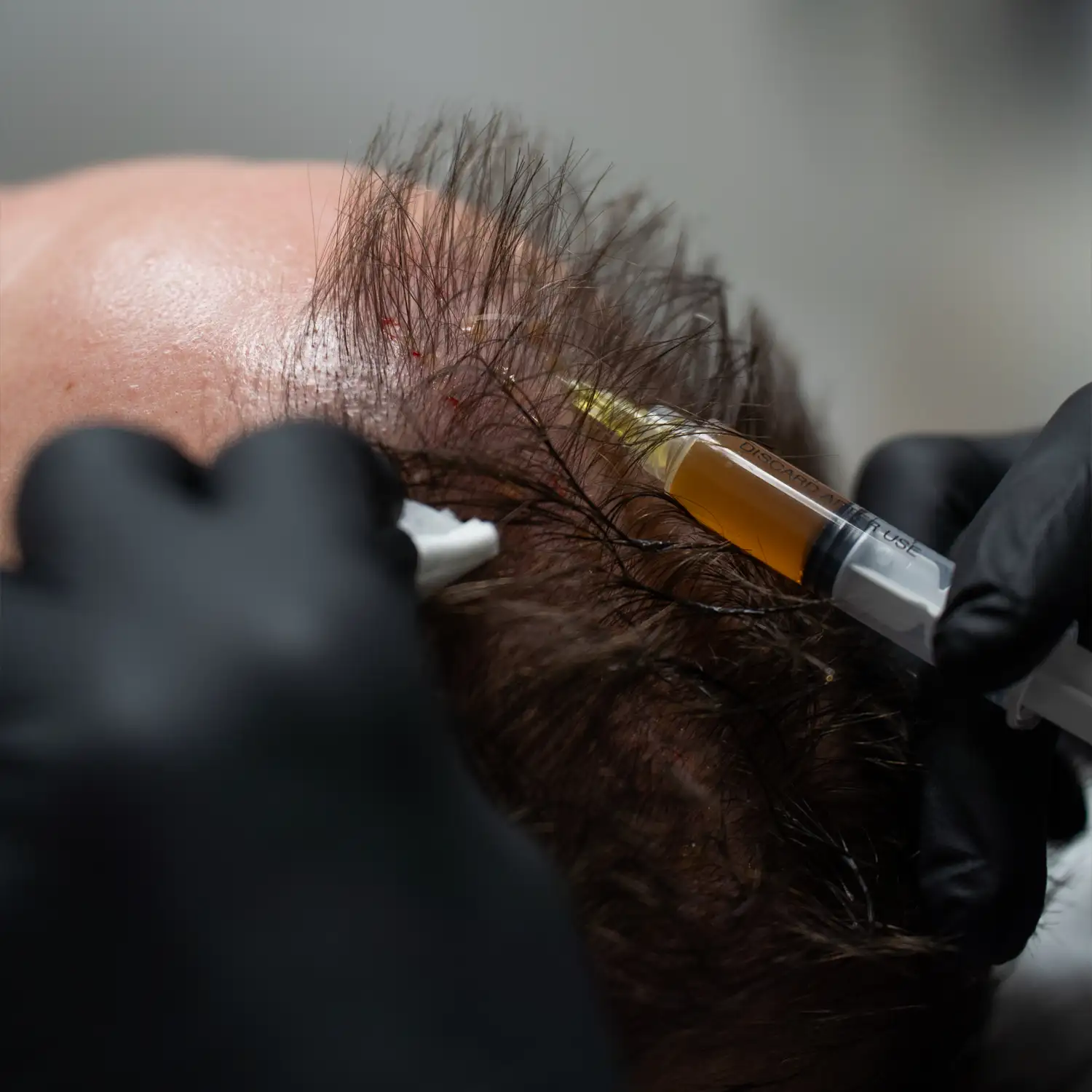 skinline-clinic-fibryna-bogatoplytkowa-na-skore-glowy-warszawa-mokotow