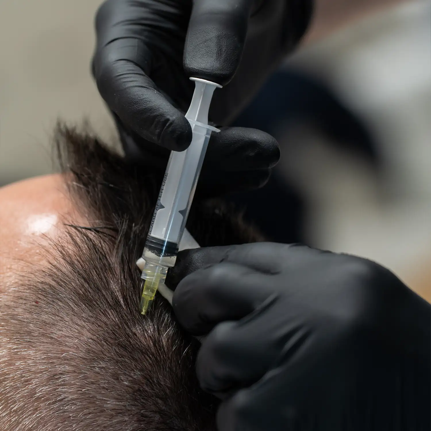 zabieg-autologiczny-plasmoo-warszawa-mokotow-skinline-clinic